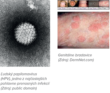 A humán papillomavírus és a szájüregi daganatok - Jóindulatú papilloma a torokban